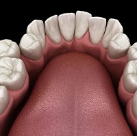 Illustration of crooked teeth