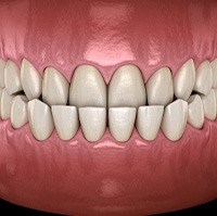 Illustration of an underbite