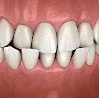 Illustration of a crossbite