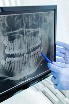 a dentist pointing to an X-ray of a patient’s mouth