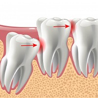 Illustration of impacted molar